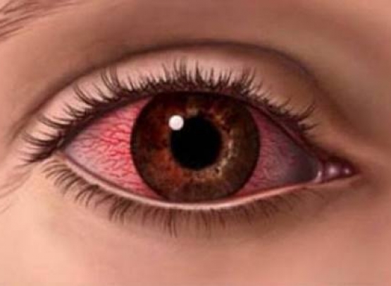 olho vermelho: pode ser doença reumatica 