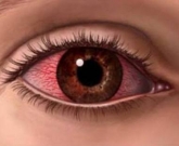 Olho vermelho: pode ser doença reumática 